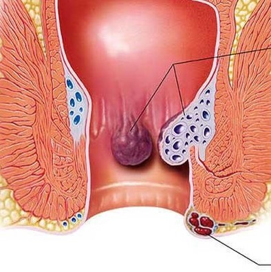 Những Biểu Hiện Báo Hiệu Bệnh Trĩ – Cách Chữa Bệnh Trĩ