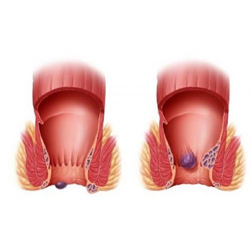 Trẻ Bị Táo Bón Đi Ngoài Ra Máu Ảnh Hưởng Sao Tới Sức Khỏe?